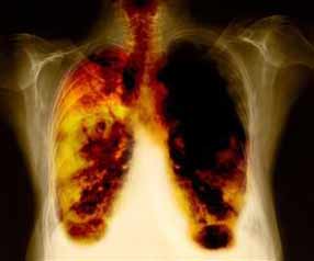 lung cancer treatment in Cuba